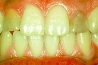 clareamento dental - antes